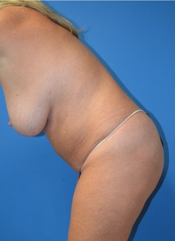 Vaser Lipoabdominoplasty After