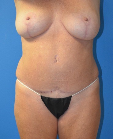 Vaser Lipoabdominoplasty After