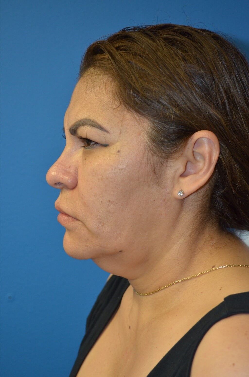 Deep plane face/necklift Before