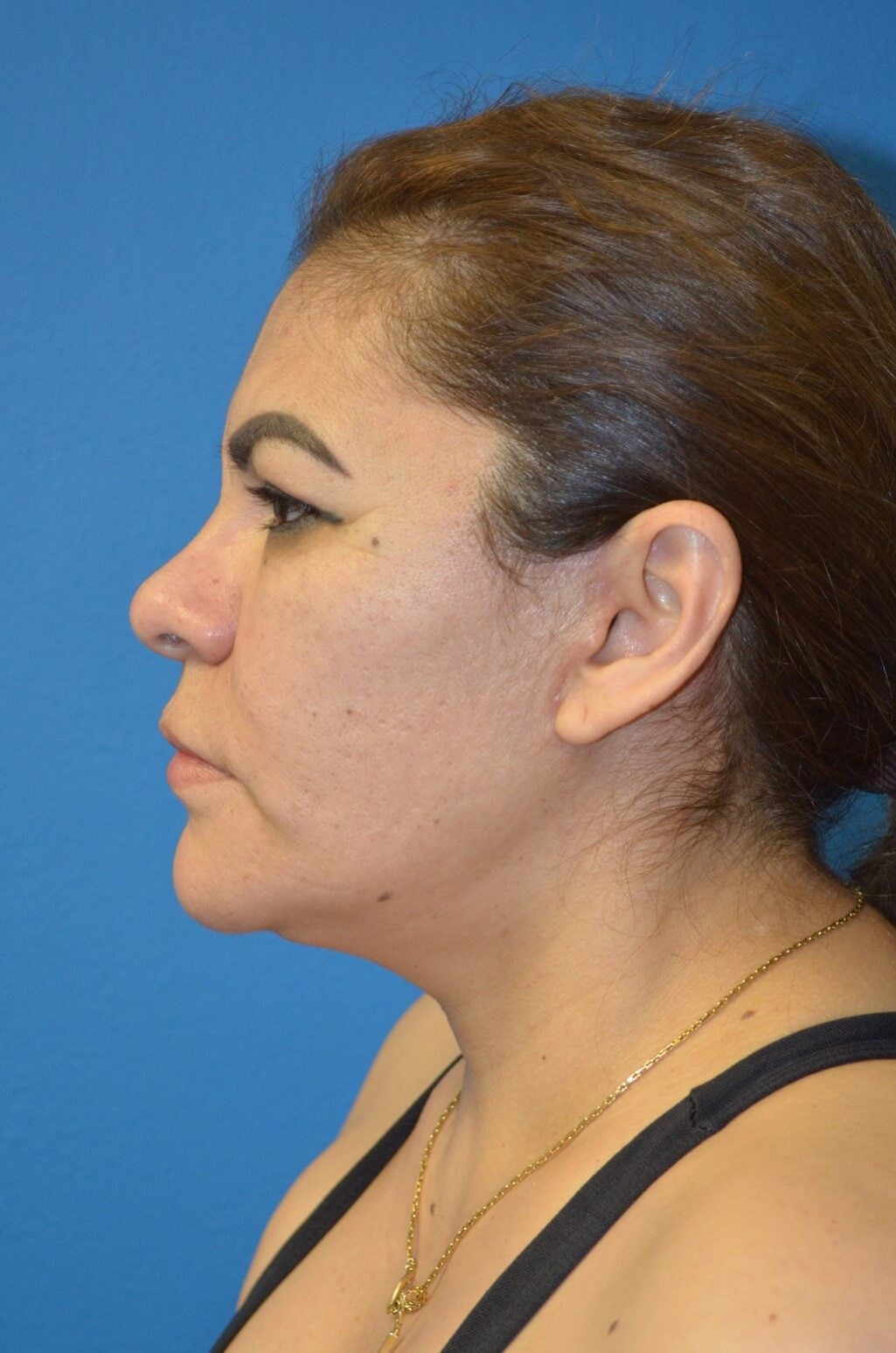 Deep plane face/necklift After
