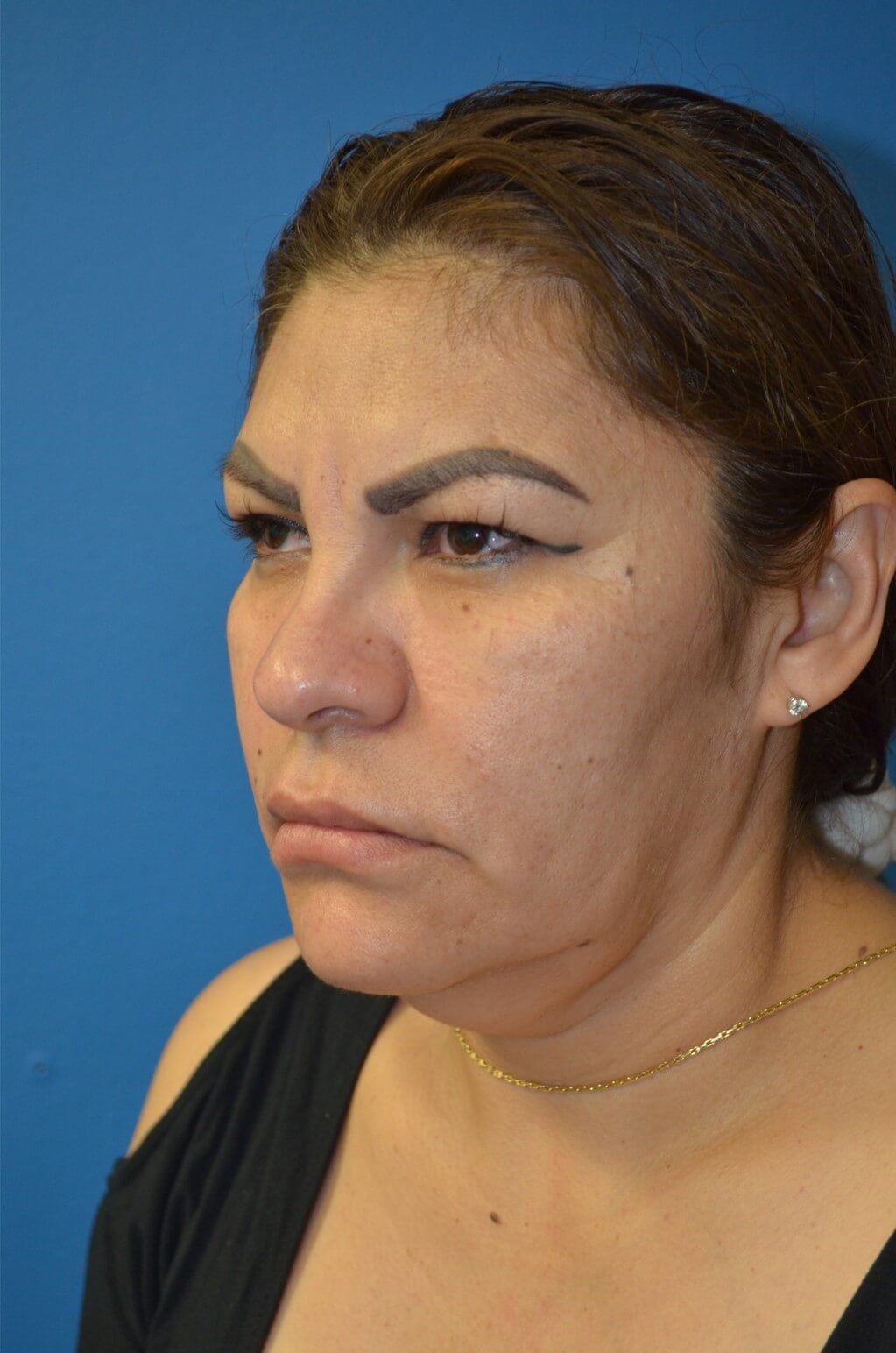 Deep plane face/necklift Before