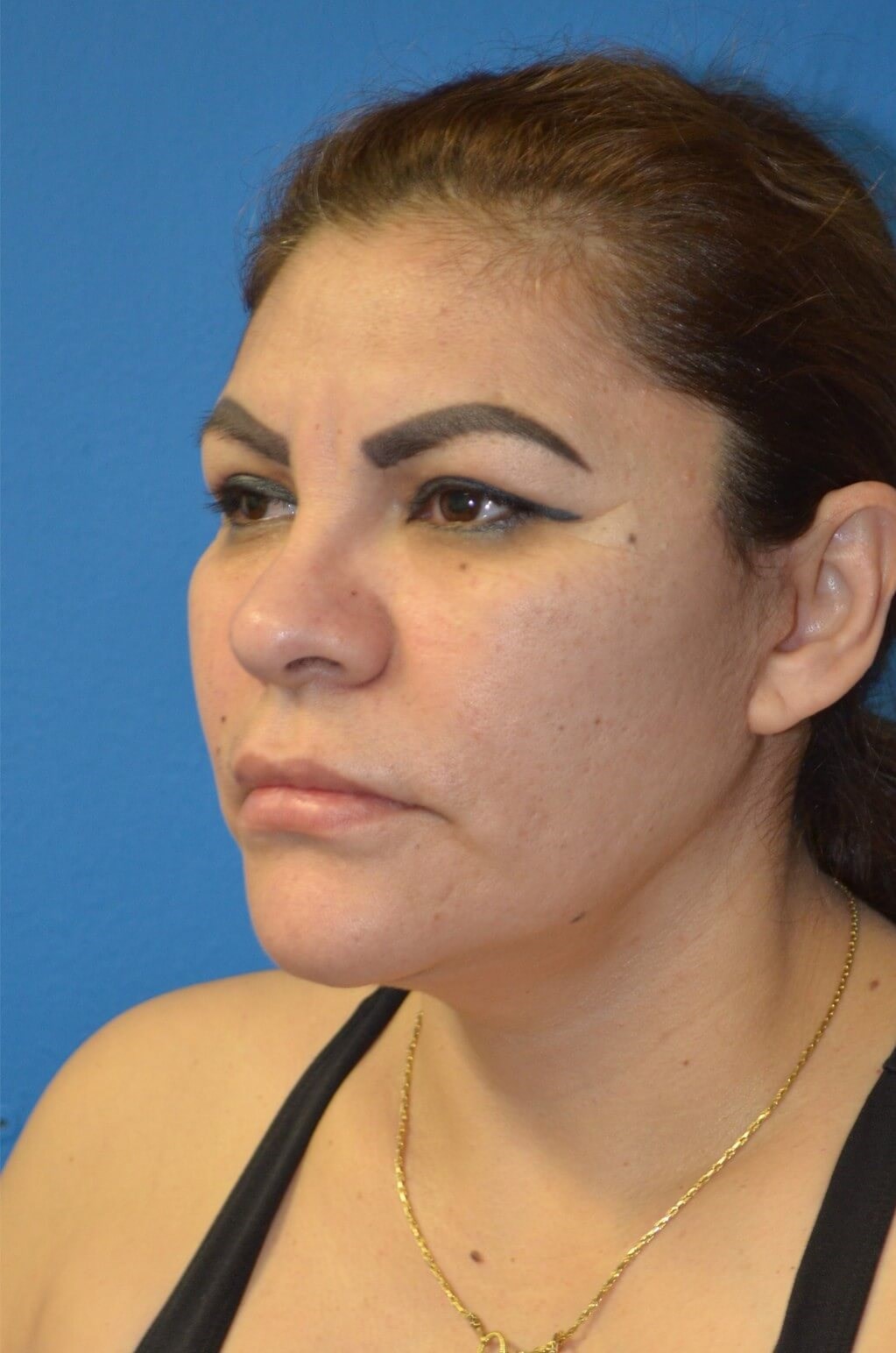 Deep plane face/necklift After