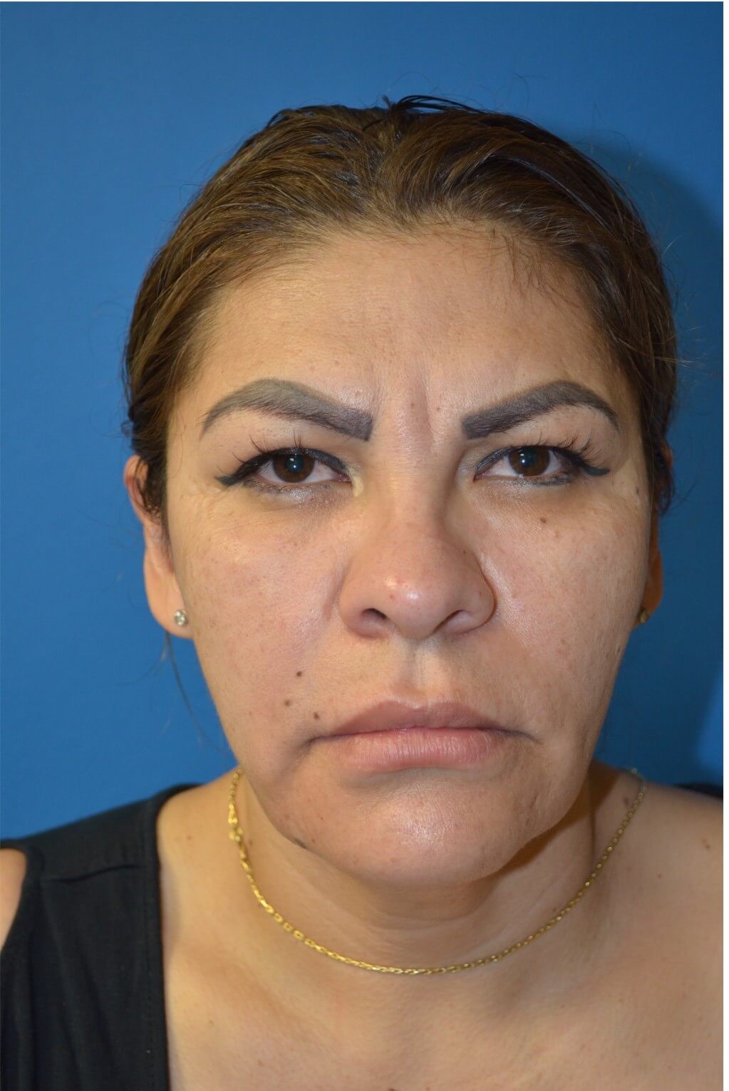 Deep plane face/necklift Before