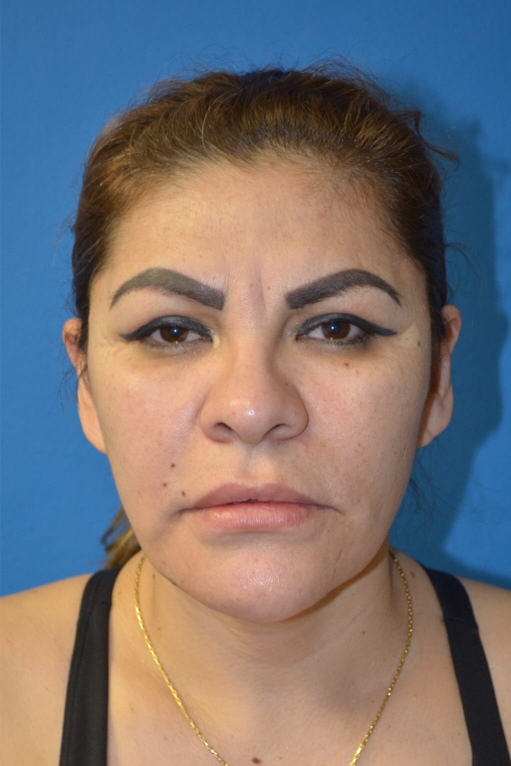 Deep plane face/necklift After