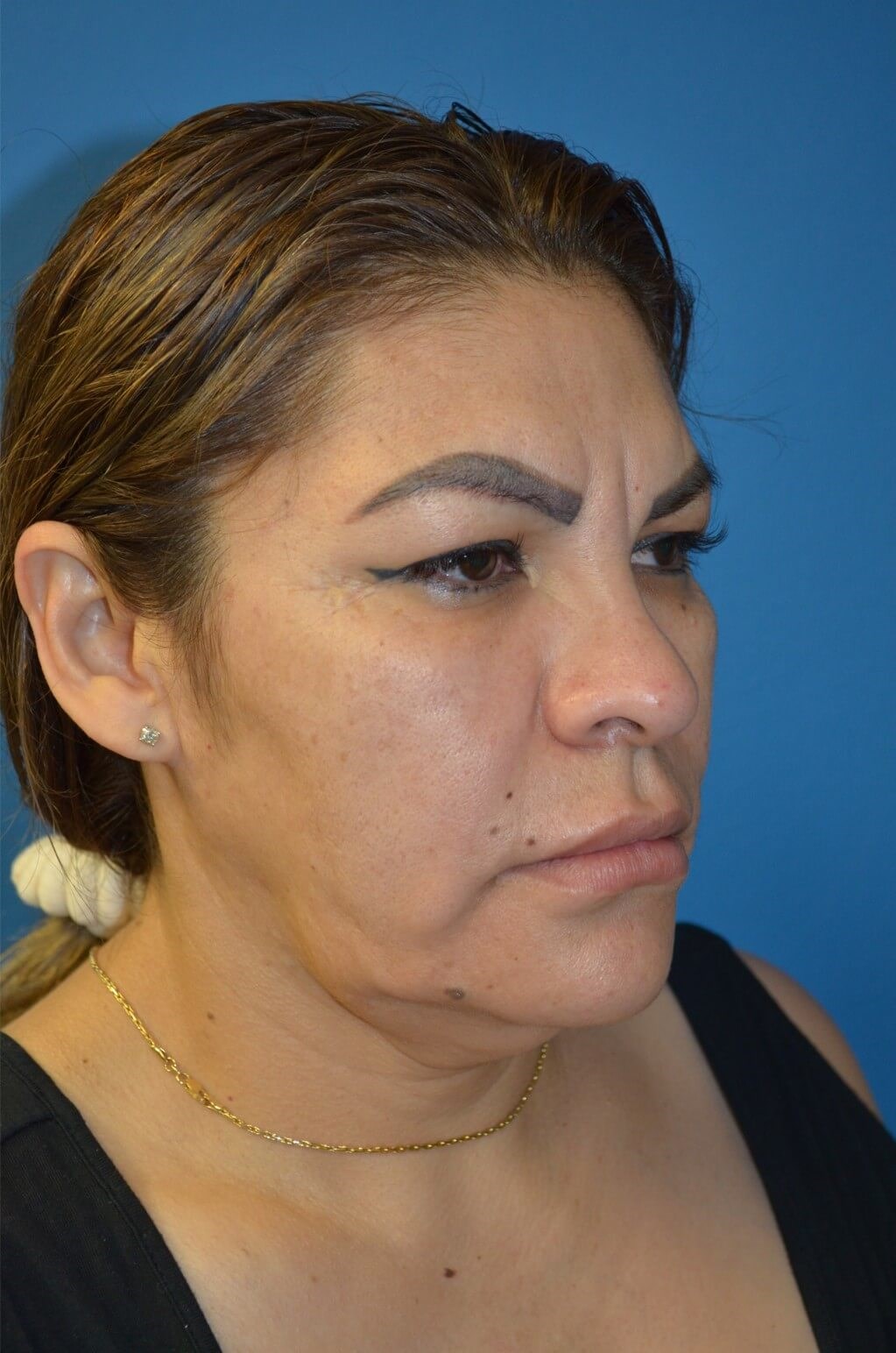 Deep plane face/necklift Before