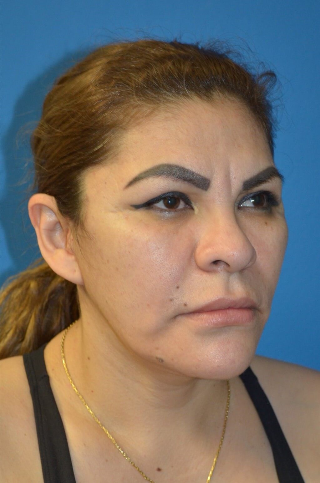 Deep plane face/necklift After