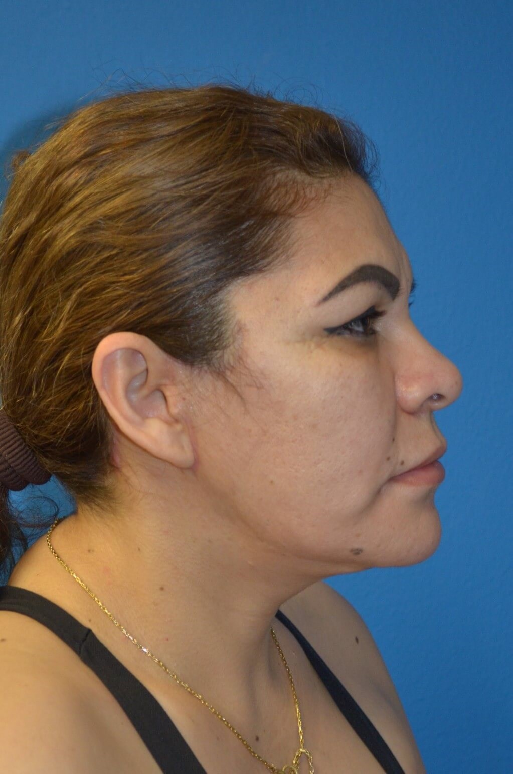 Deep plane face/necklift After