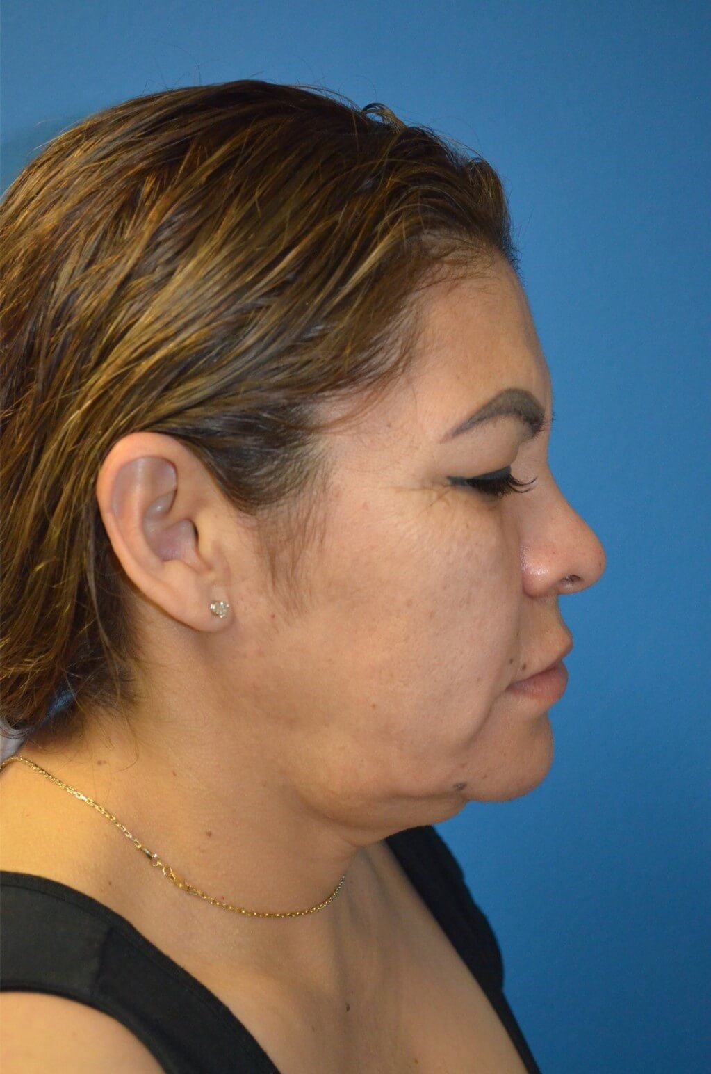 Deep plane face/necklift Before