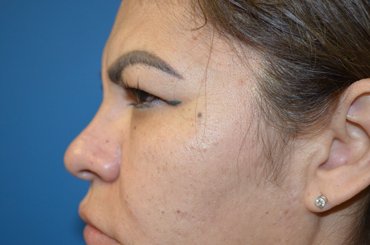 Secondary Upper Lid Lift Before