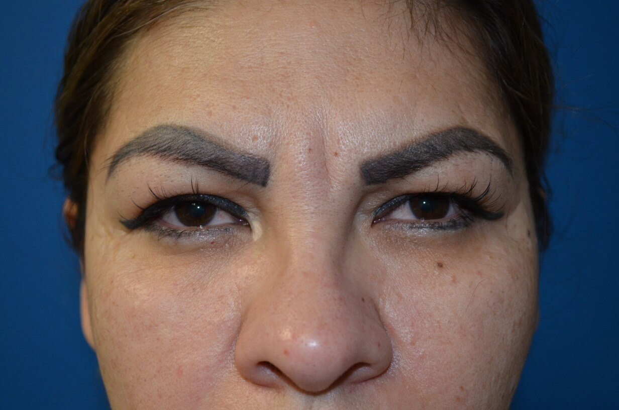 Secondary Upper Lid Lift Before