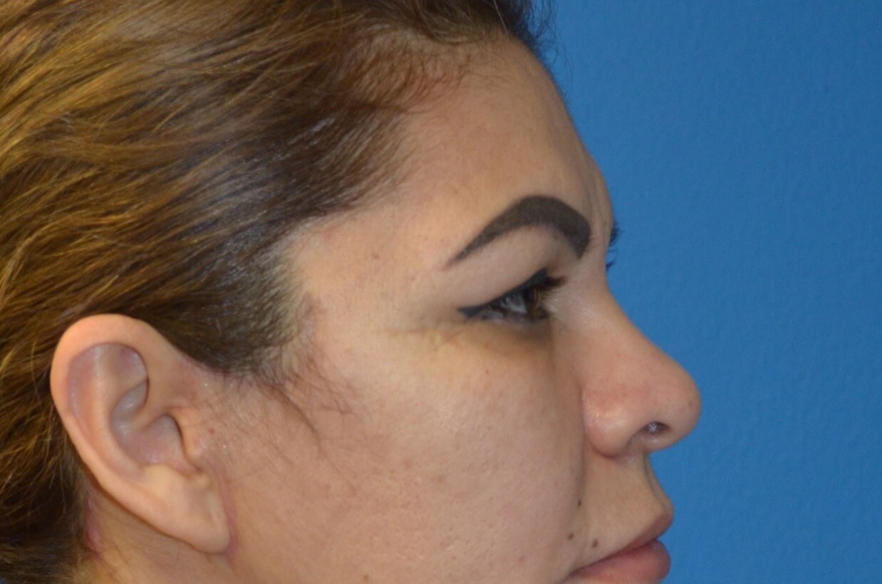 Secondary Upper Lid Lift After