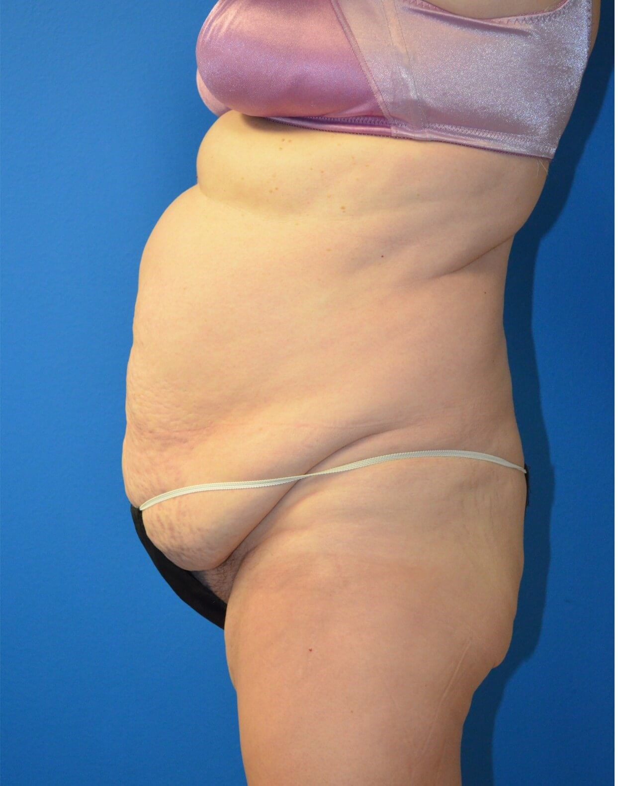 Vaser Lipoabdominoplasty Before