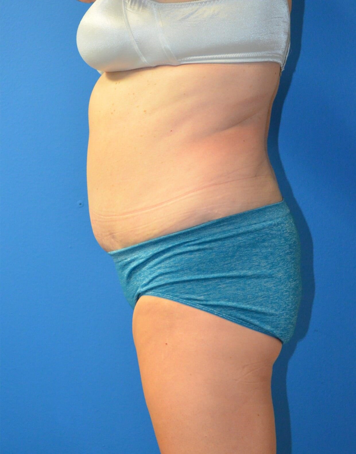 Vaser Lipoabdominoplasty After