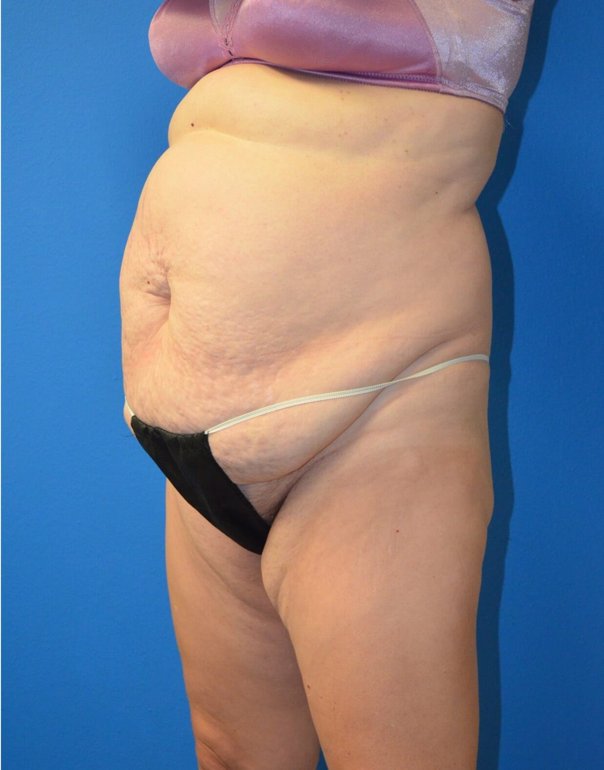 Vaser Lipoabdominoplasty Before
