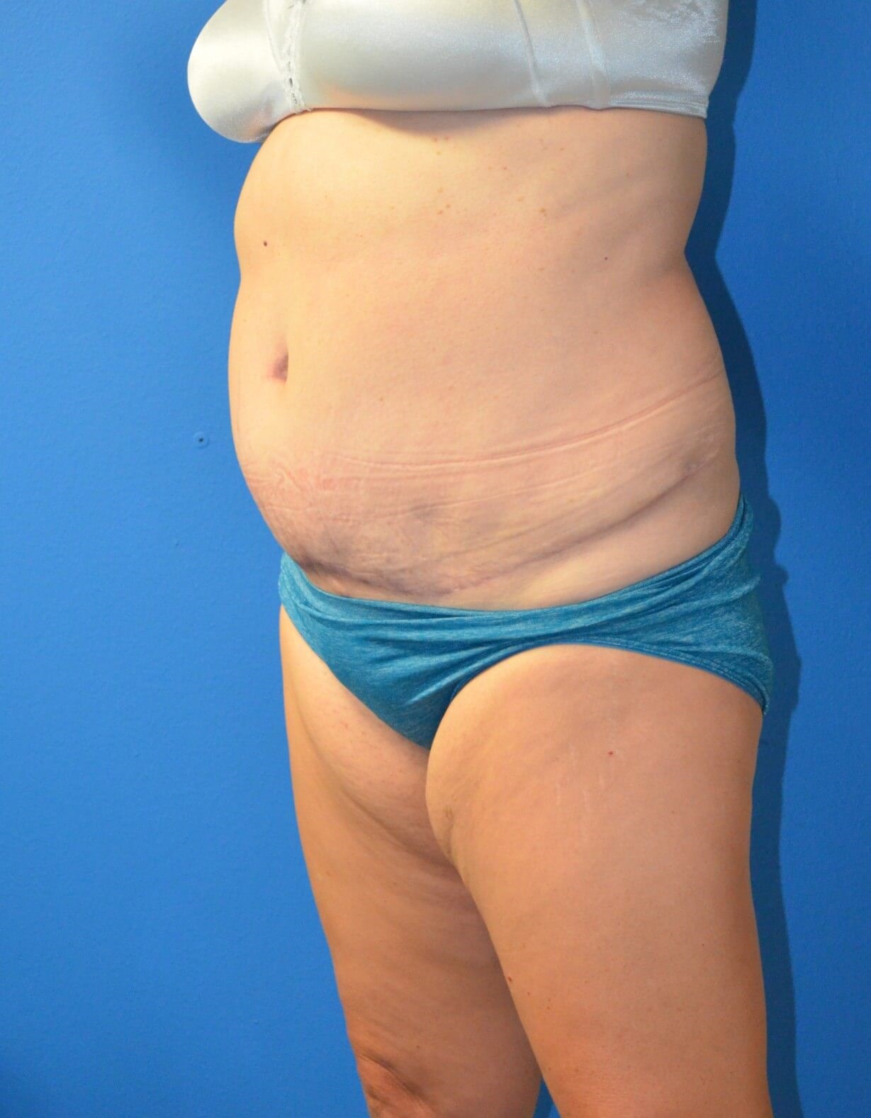 Vaser Lipoabdominoplasty After