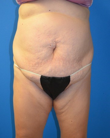 Vaser Lipoabdominoplasty Before