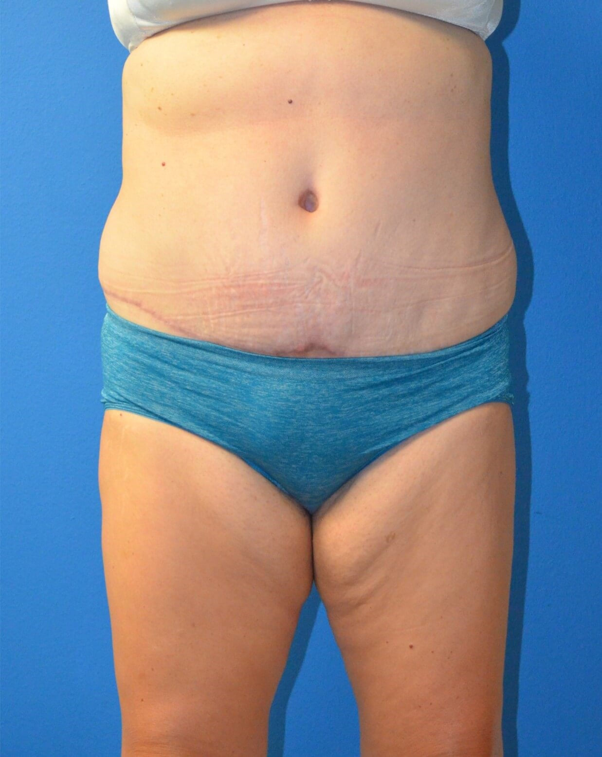 Vaser Lipoabdominoplasty After
