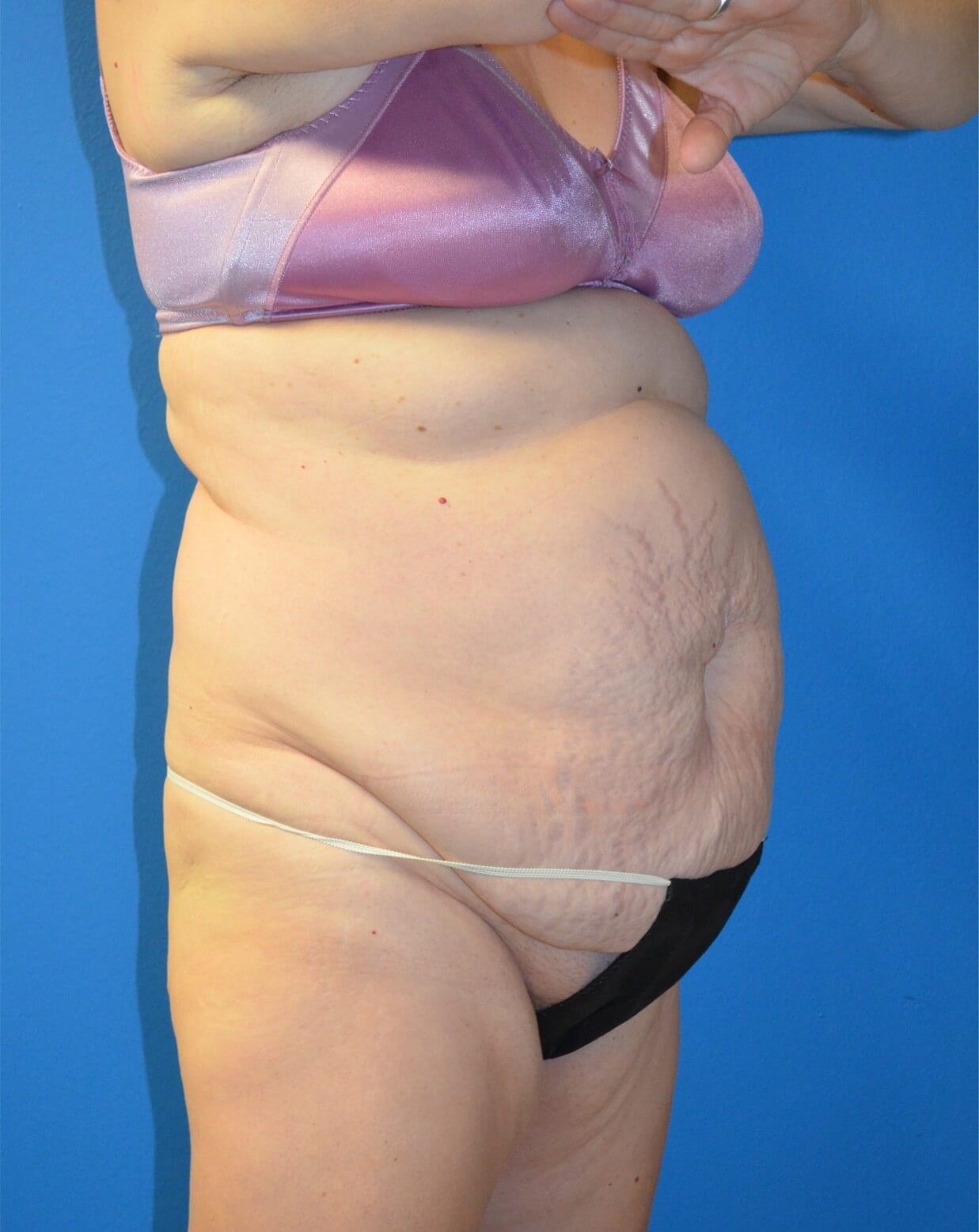 Vaser Lipoabdominoplasty Before