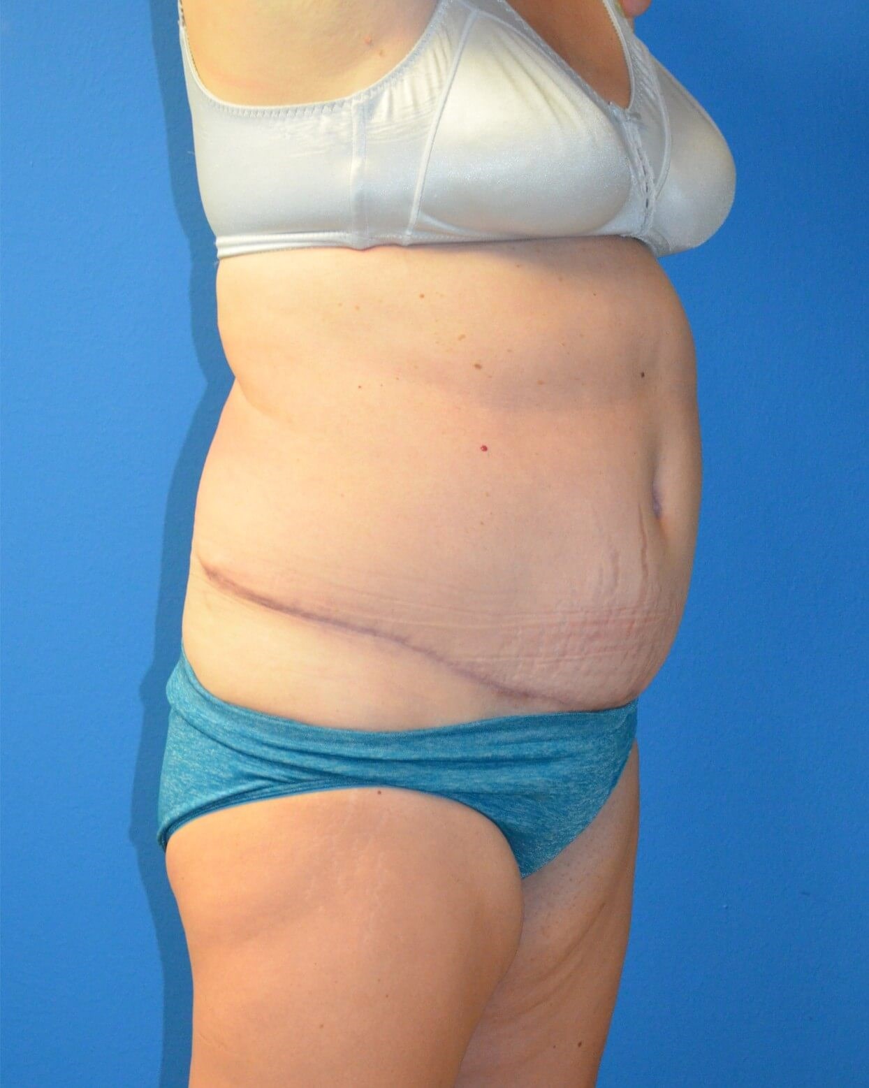 Vaser Lipoabdominoplasty After