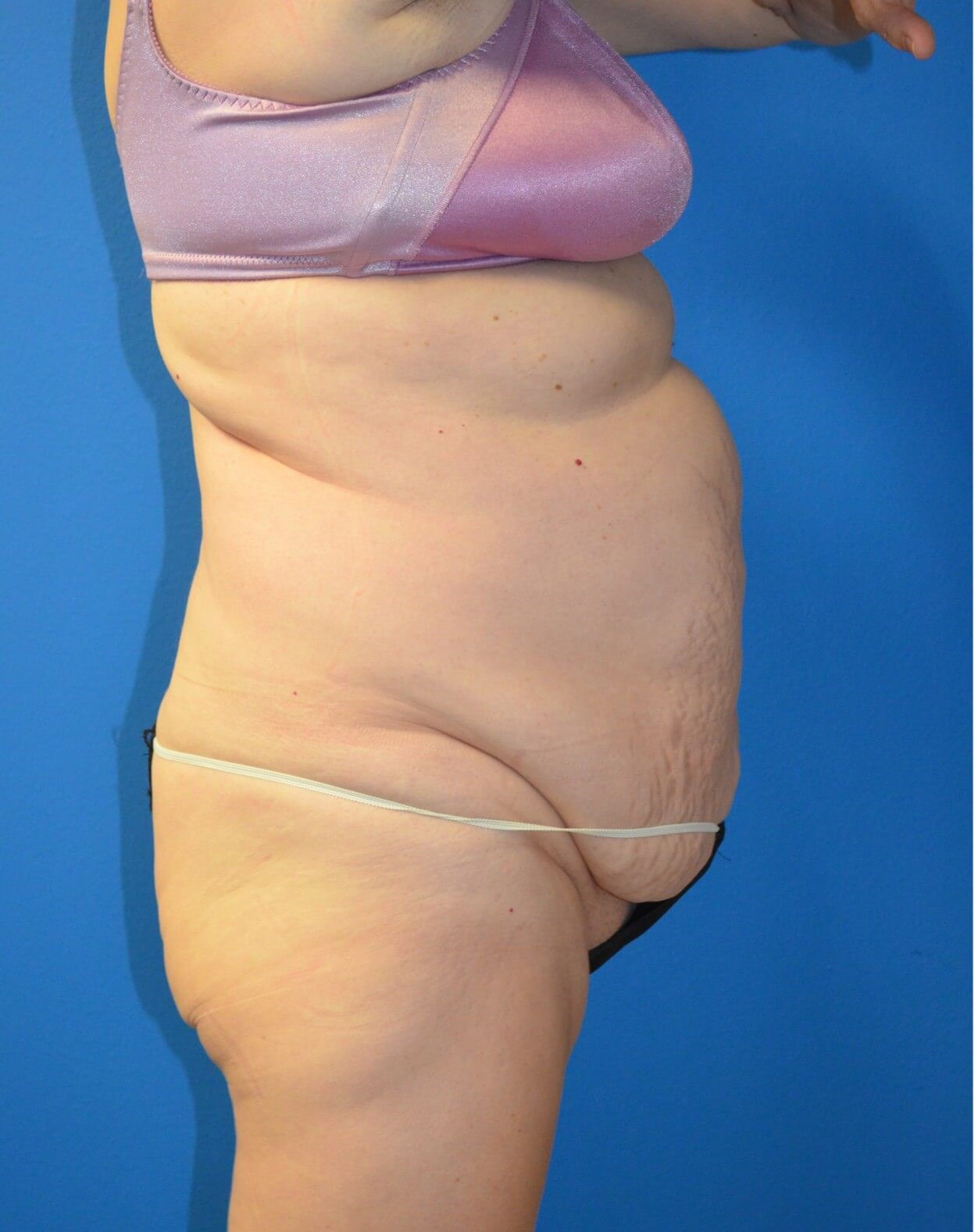 Vaser Lipoabdominoplasty Before
