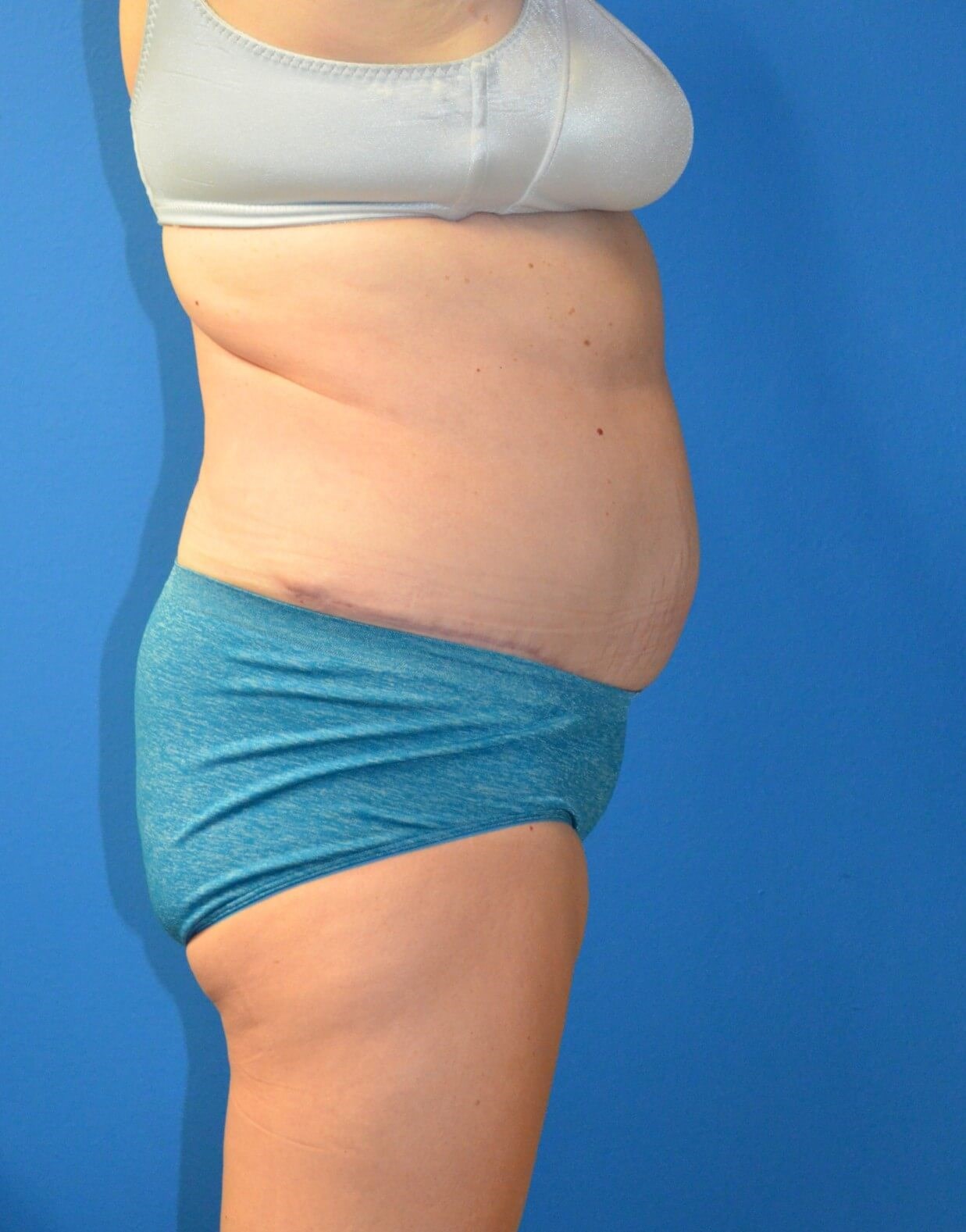 Vaser Lipoabdominoplasty After