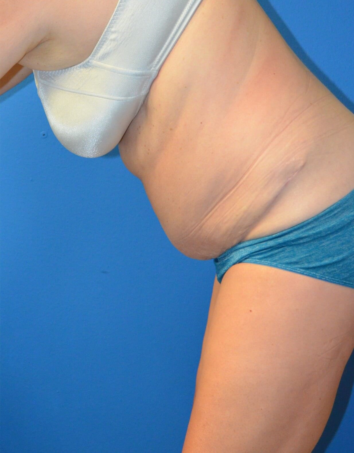 Vaser Lipoabdominoplasty After