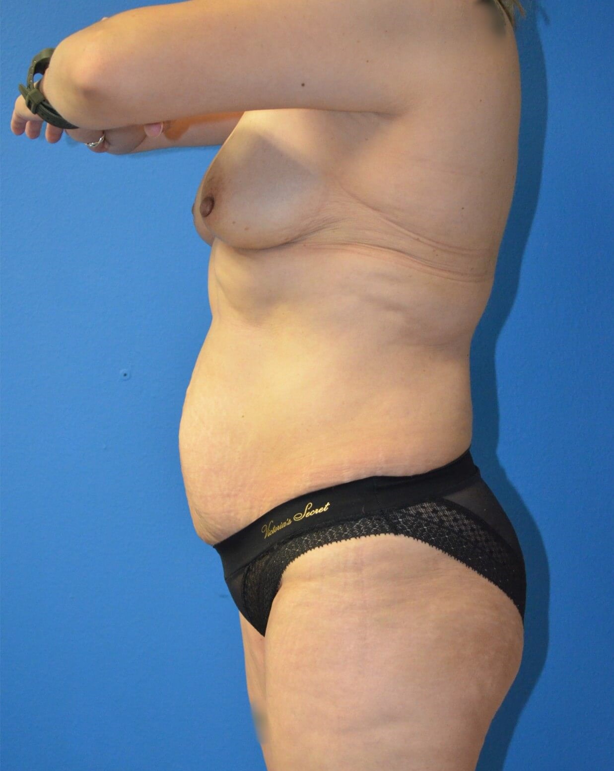 Vaser Lipoabdominoplasty Before