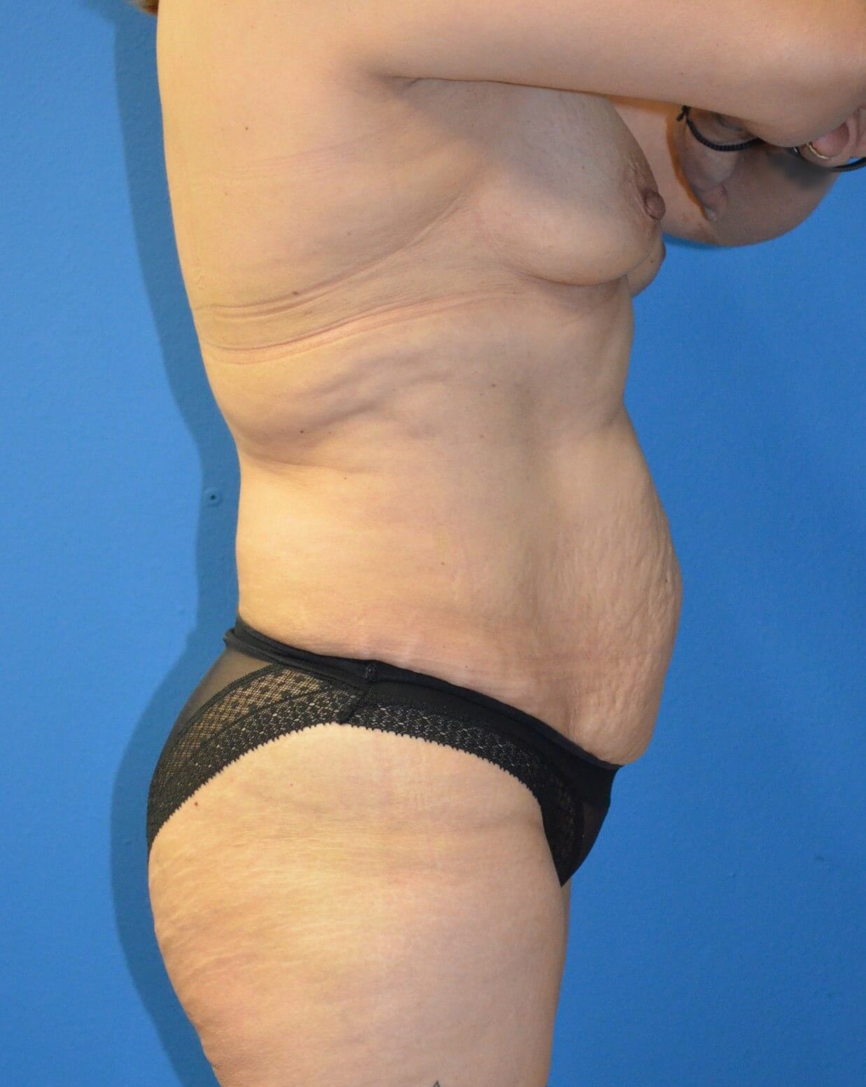 Vaser Lipoabdominoplasty Before