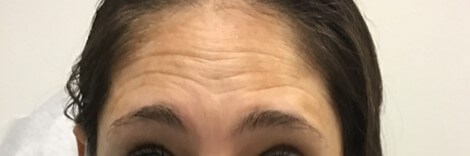 Botox/Dysport Forehead Before