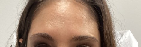 Botox/Dysport Forehead After