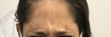 Botox/Dysport Forehead Before