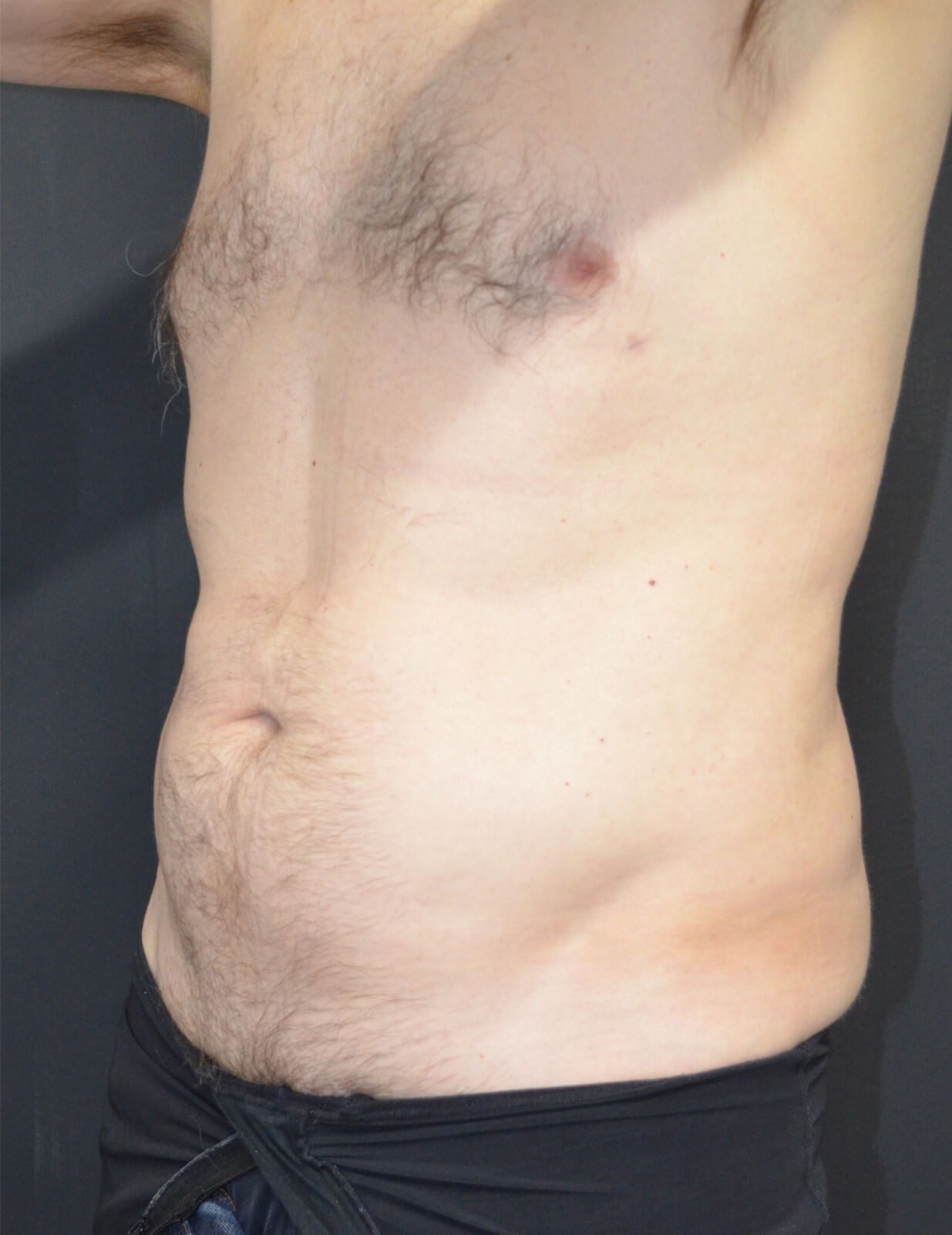 Vaser Liposculpture After