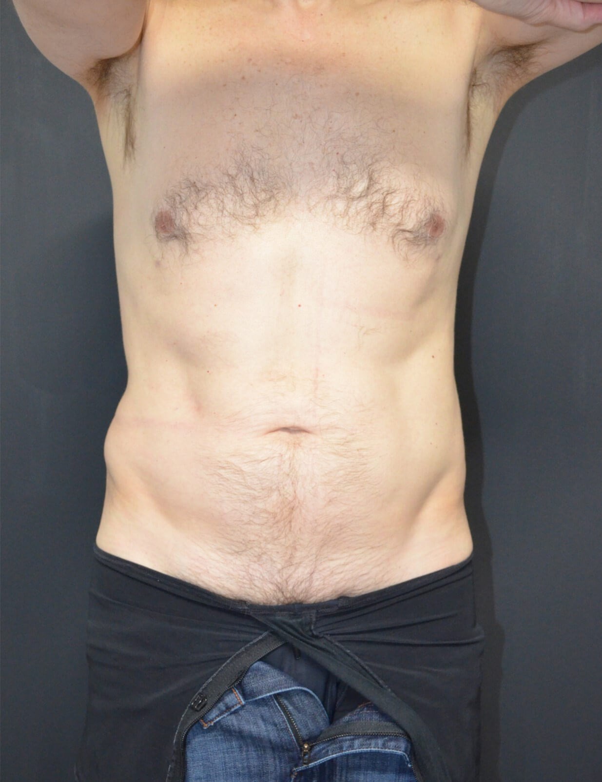 Vaser Liposculpture After