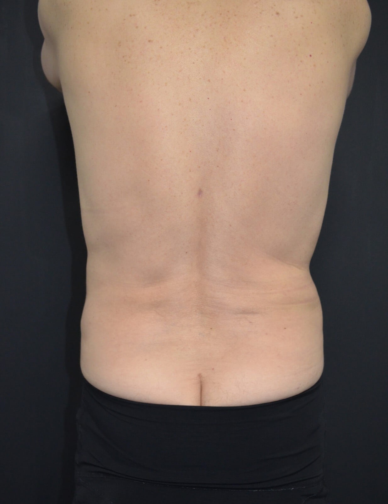 Vaser Liposculpture After