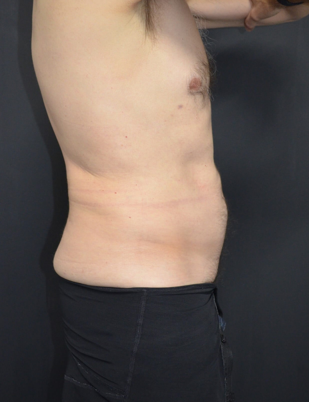 Vaser Liposculpture After