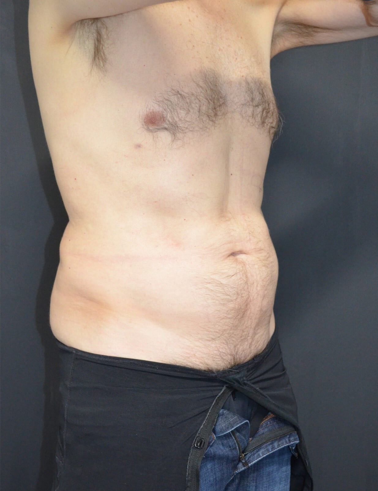 Vaser Liposculpture After