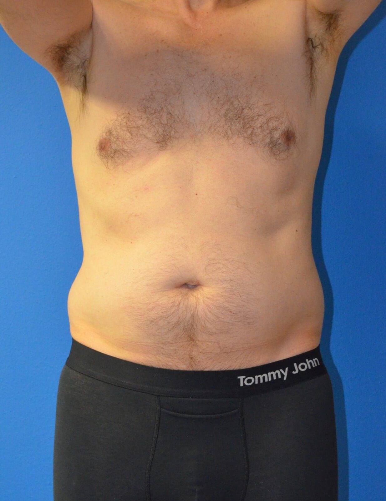 Vaser Liposculpture Before