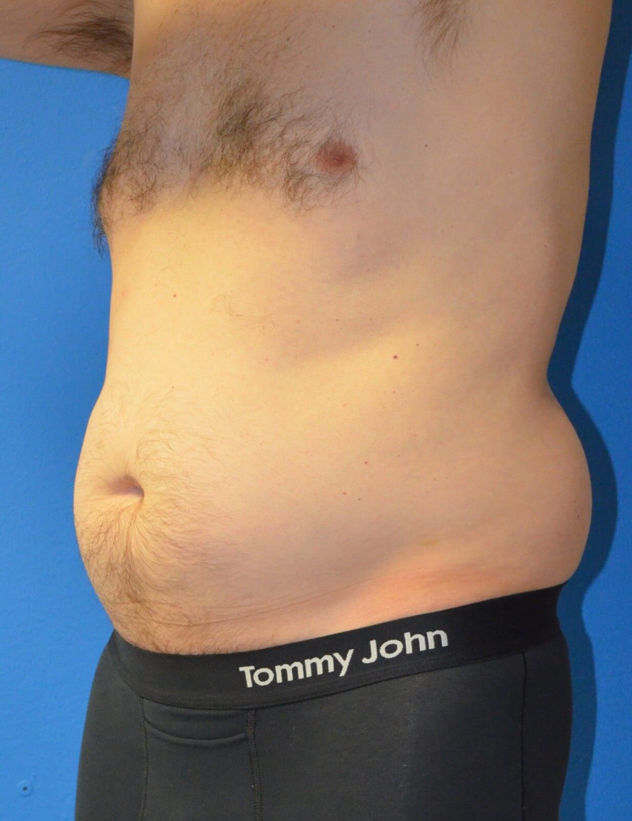 Vaser Liposculpture Before