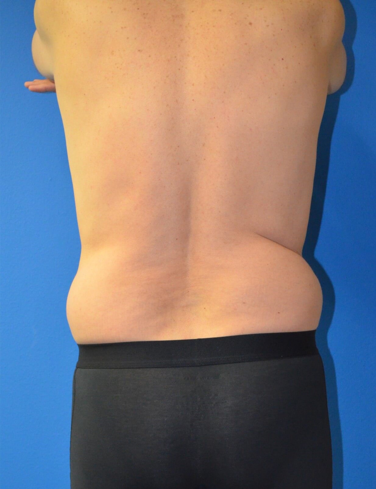 Vaser Liposculpture Before