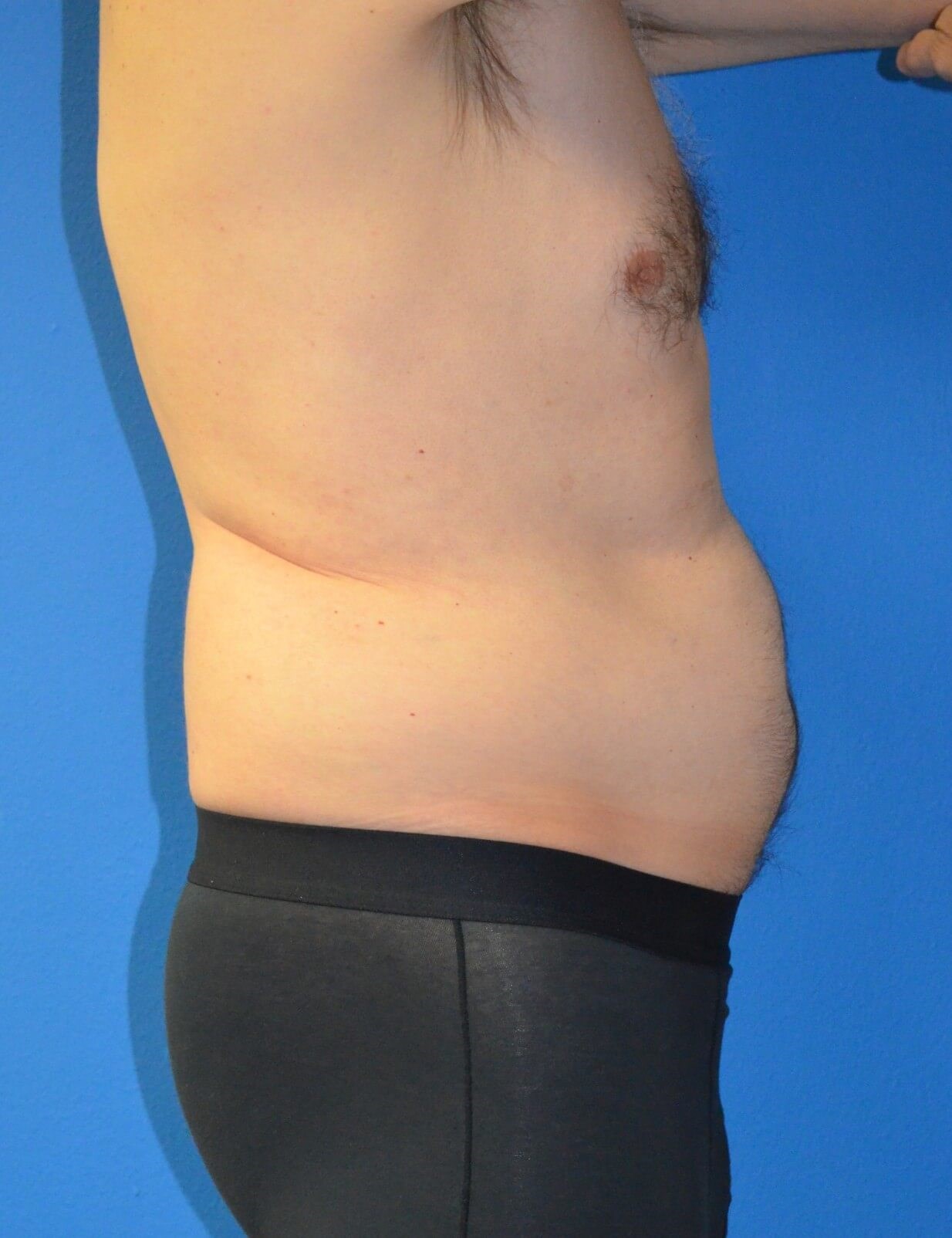 Vaser Liposculpture Before