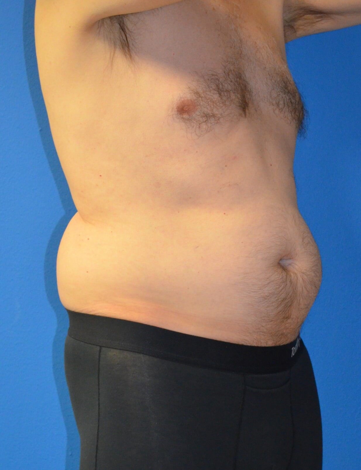 Vaser Liposculpture Before