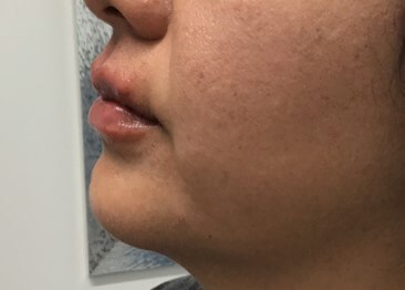 Lip Filler Restylane Kysse After