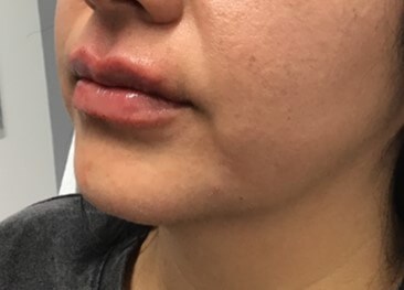 Lip Filler Restylane Kysse After