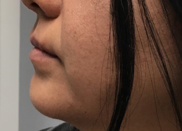 Lip Filler Restylane Kysse Before