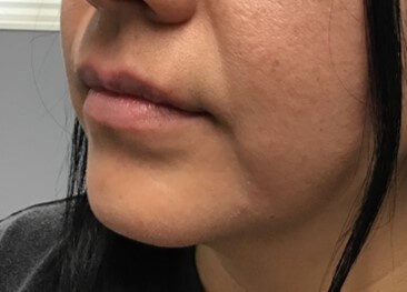 Lip Filler Restylane Kysse Before