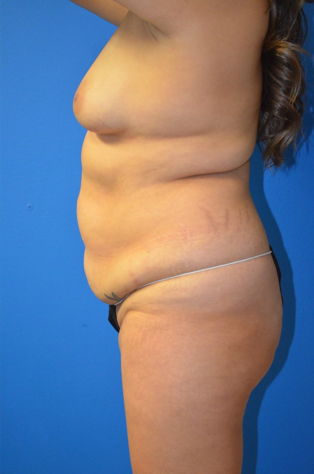 Lipoabdominoplasty and Lipo360 Before