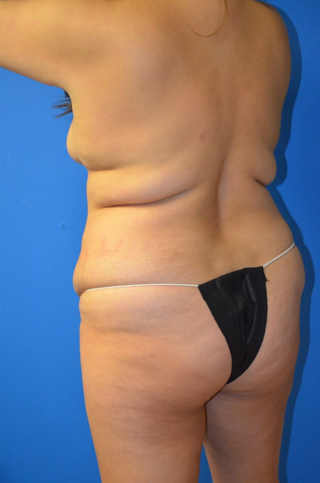 Lipoabdominoplasty and Lipo360 Before
