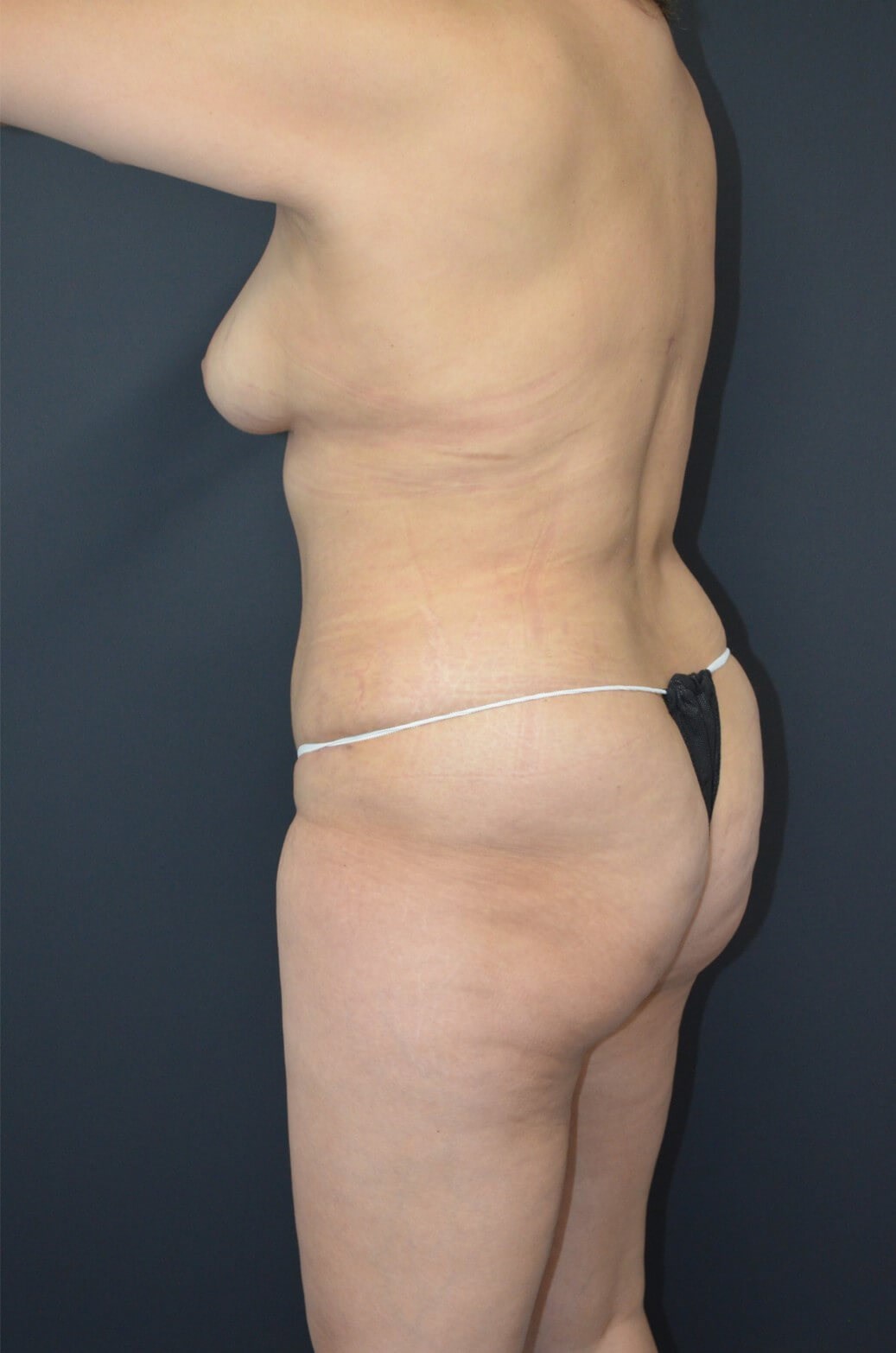 Lipoabdominoplasty and Lipo360 After
