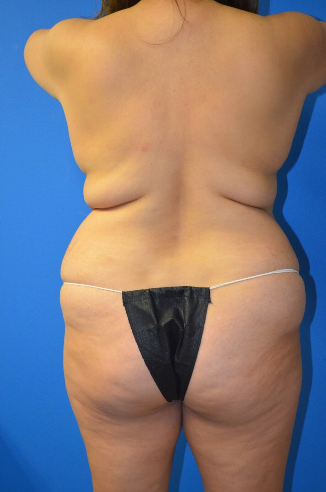 Lipoabdominoplasty and Lipo360 Before