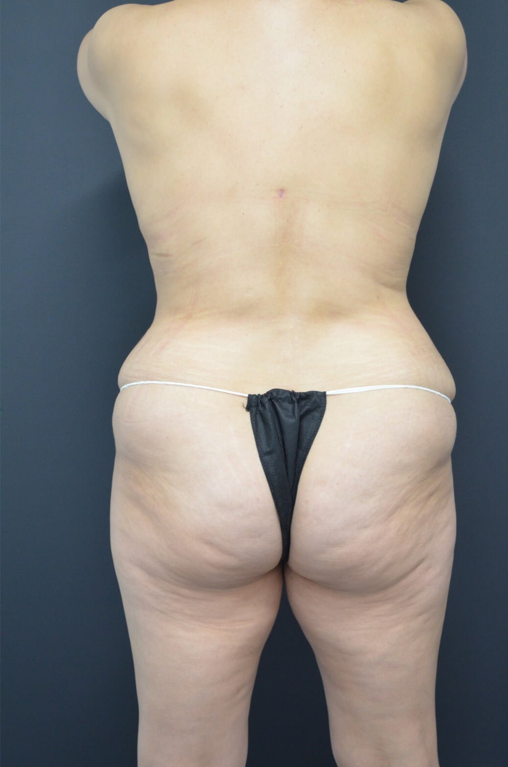 Lipoabdominoplasty and Lipo360 After